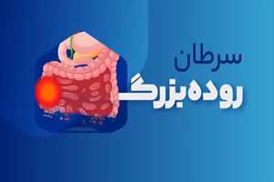 سرطان روده بزرگ 