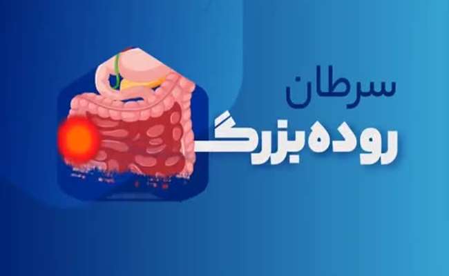 سرطان روده بزرگ 